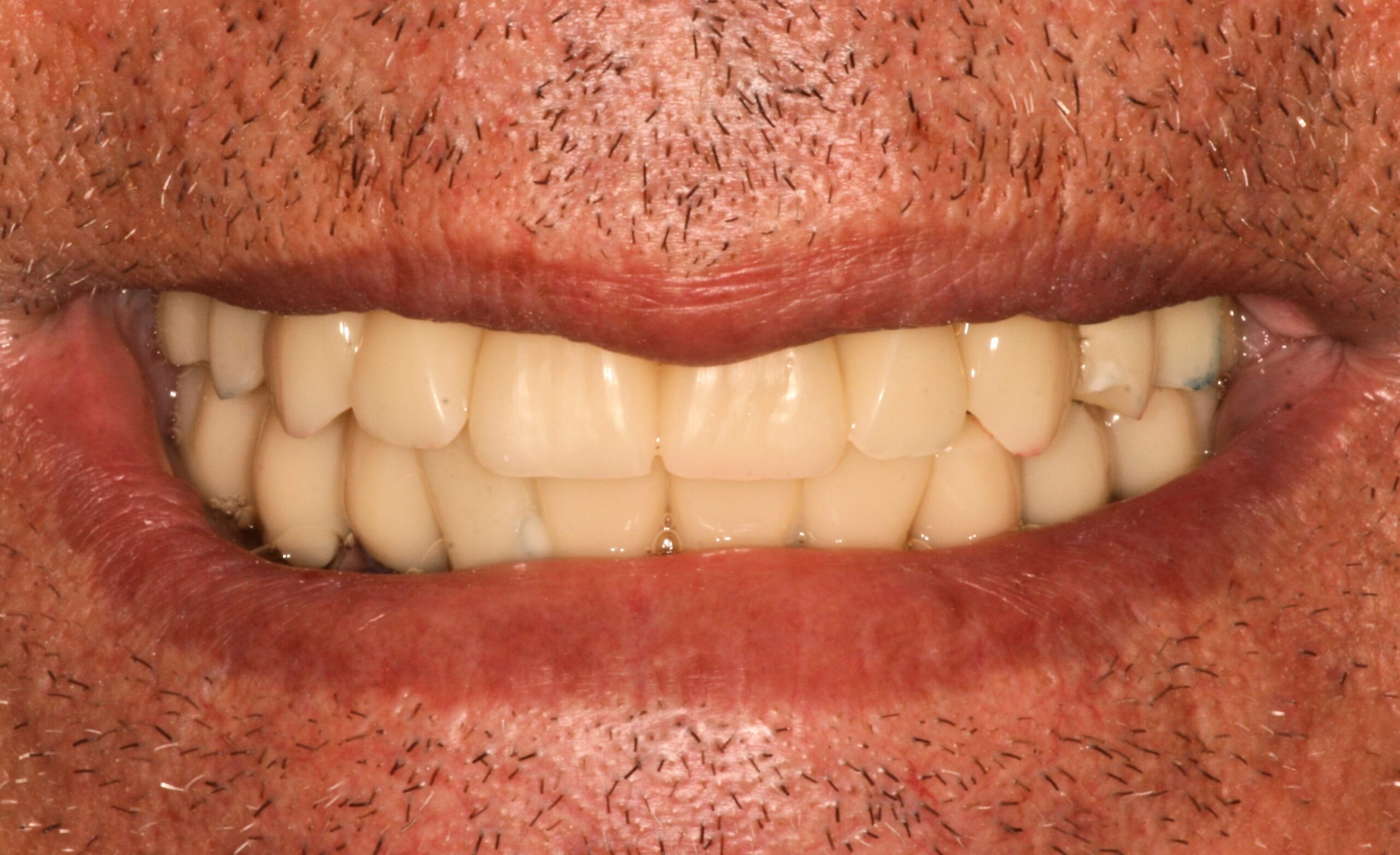 Μεταβατική σταθερή αποκατάσταση