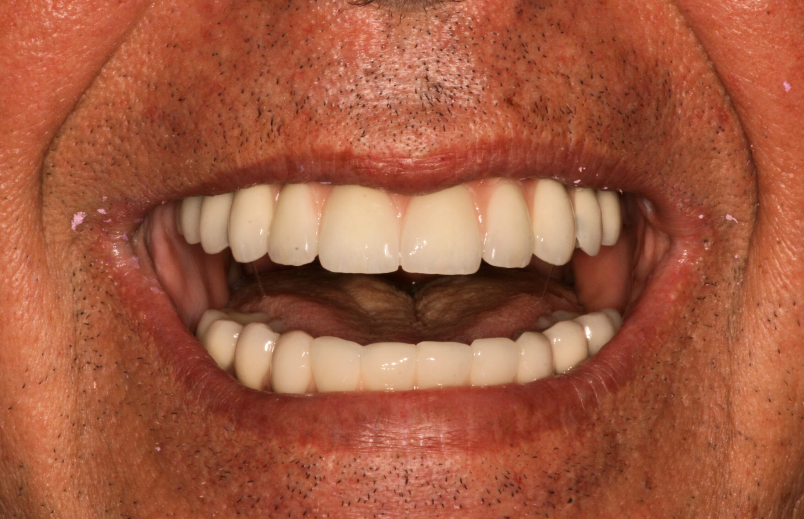 Οριστική αποκατάσταση