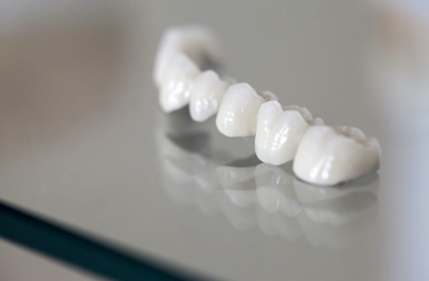 προσωρινή γέφυρα δοντιών