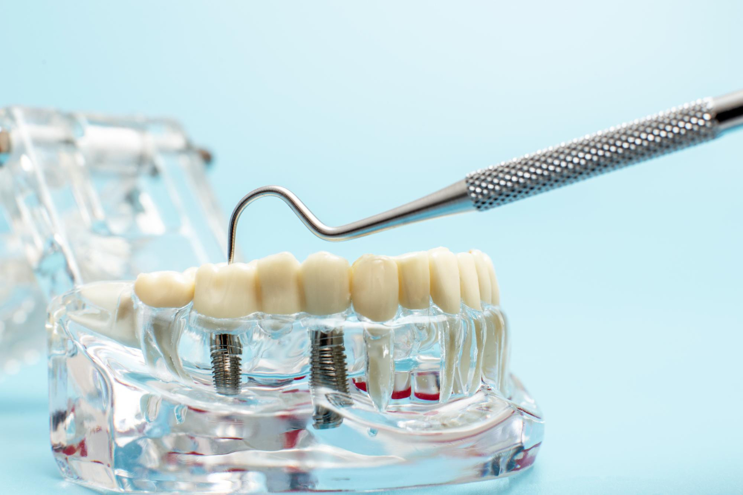 επένθετη οδοντοστοιχία